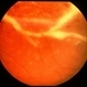 CMV Frosted Branch Angitis
